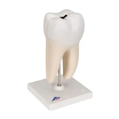 RADACINA MOLAR INFERIOR CU PREZ CAVITATILOR(3B)