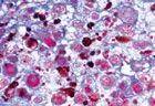 SECTIUNI MICROSCOPICE PATOLOGII HISTOLOGICE UMANE